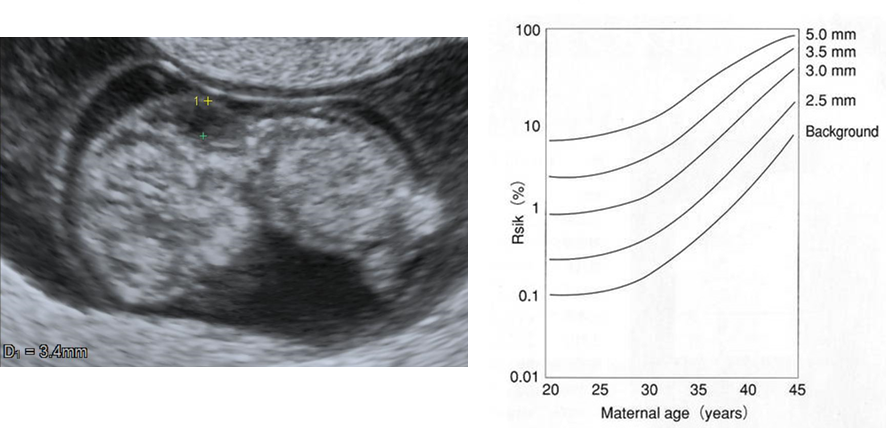 NTの計測例 (左)と、母胎年齢とNT肥厚に基づくダウン症候群のリスク (右)